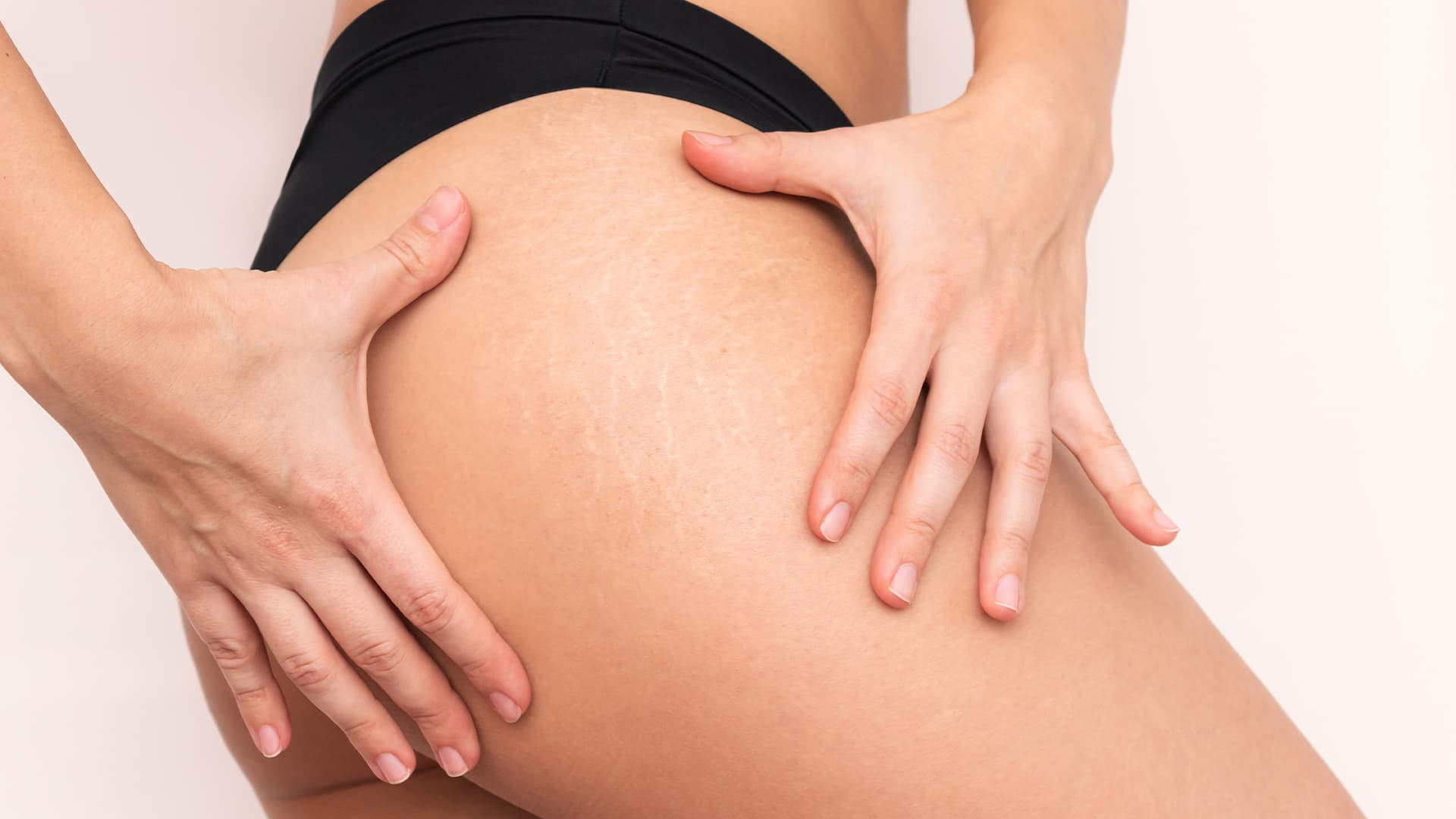 Cilt Çatlağı Nedir? Neden Oluşur, Belirtileri ve Çatlak Bakım Rehberi