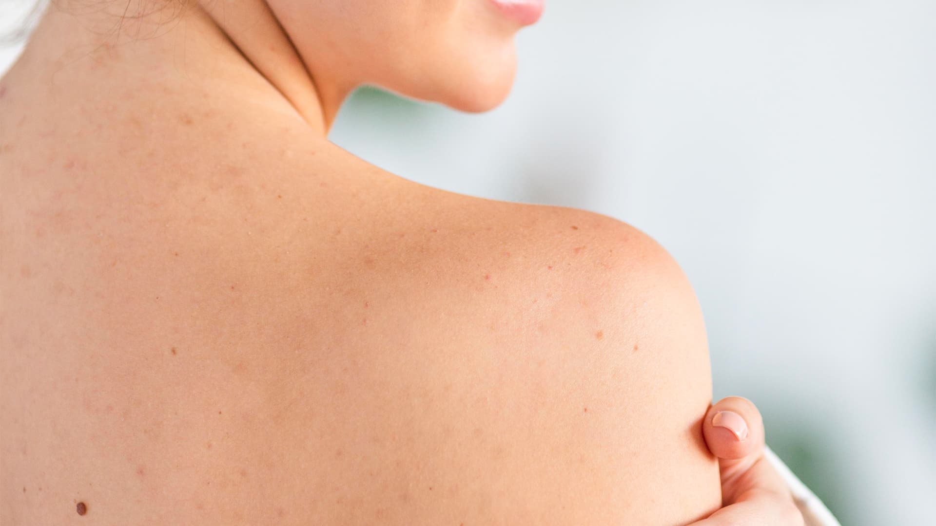 Sırt ve Vücut Sivilceleri (Backne) Neden Olur? Tedavi ve Bakım Rehberi